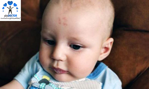 تولد نوزادی که عدد ۱۲ روی پیشانی‌اش درج شده + عکس