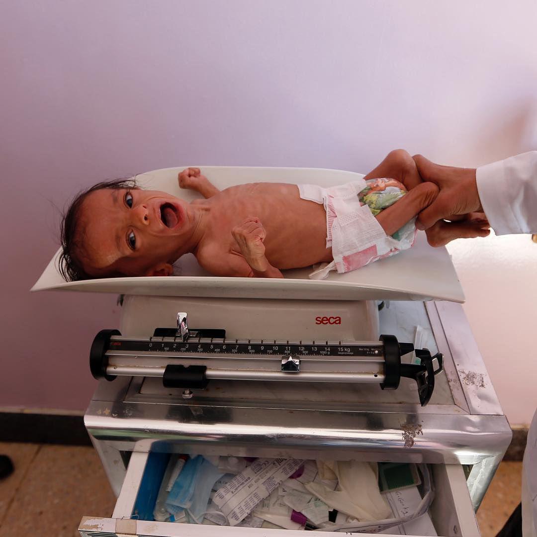 تصویر تکان دهنده بی بی سی از کودک یمنی