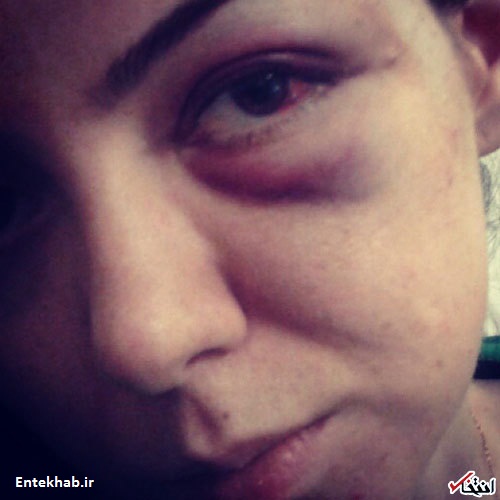 ادعای «آزاده نام‌داری» از ضرب‌وشتم خود توسط فرزاد حسنی + عکس