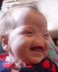 نوزادی که بینی ندارد +عکس