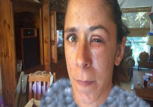 وقتی چسب قطره‌ای با قطره چشم اشتباه گرفته شود + تصاویر