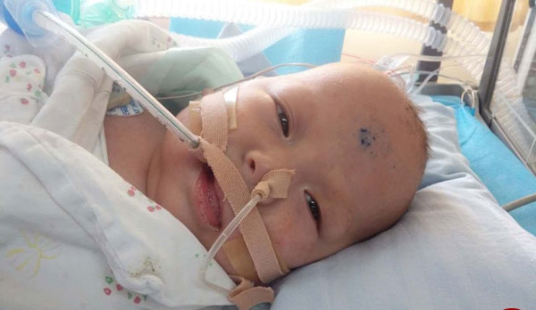 تصاویر/ جدا‌سازی دو‌قلوهای چینی