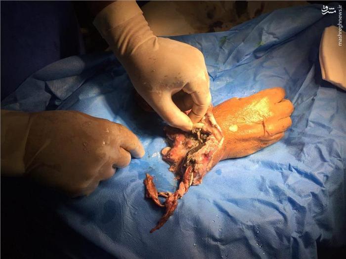 پیوند دست قطع شده در رشت +16/عکس