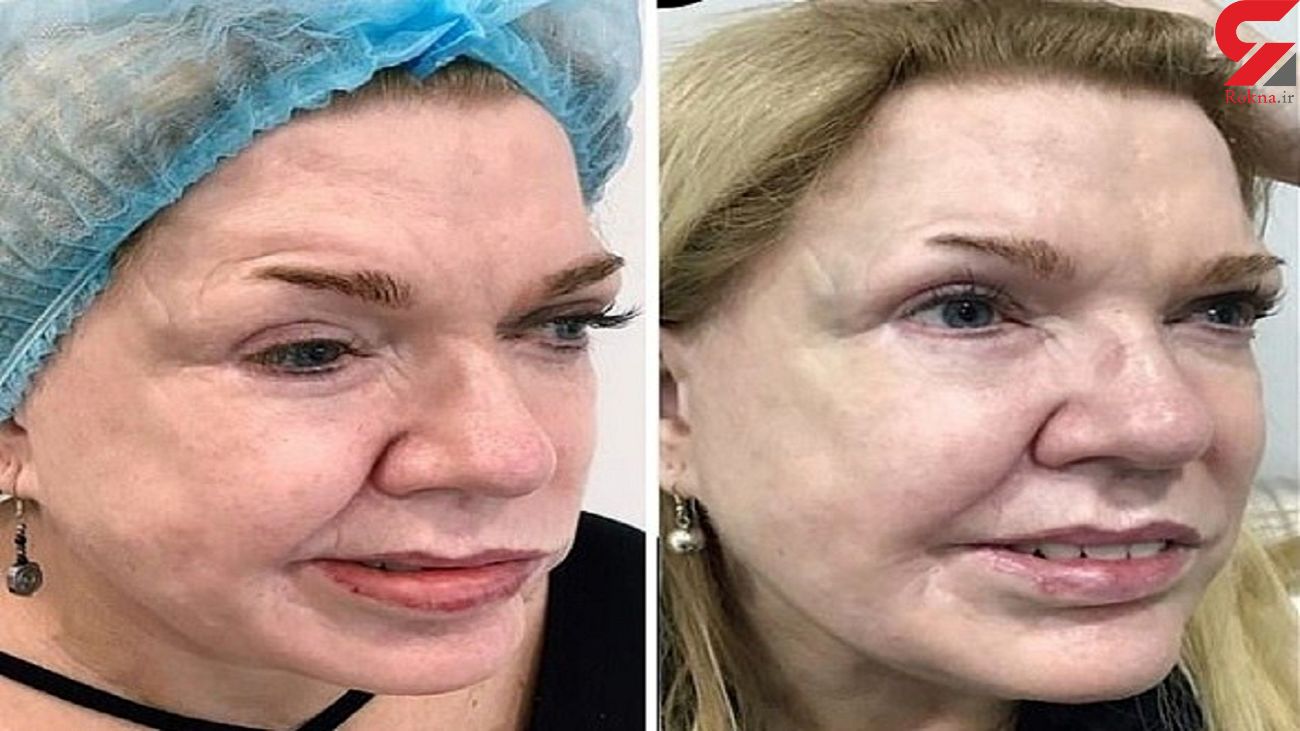 عکس باورنکردنی از تغییر قیافه یک زن با تزریق بوتاکس