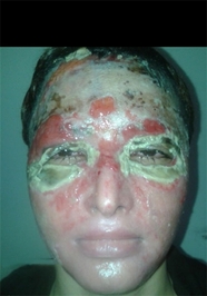 سزای پدری که به دخترش اسید پاشید