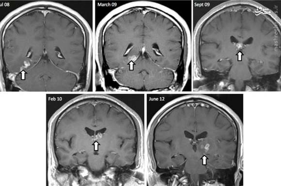 کشف کرم 4سانتی در مغز مرد انگلیسی+عکس